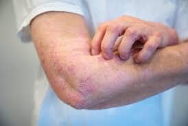 Comprendre le psoriasis : symptômes, causes et traitements – Slolie