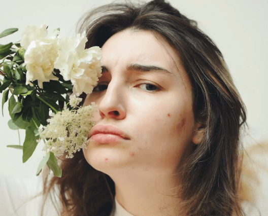 Qu'est ce que l'acné et comment la traiter naturellement ?